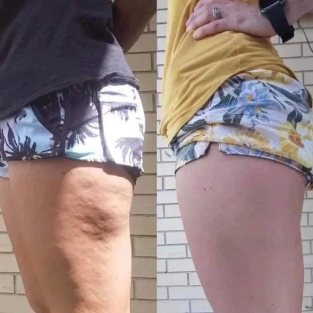 Before and after - cellulite faded, firmer lifted bottom