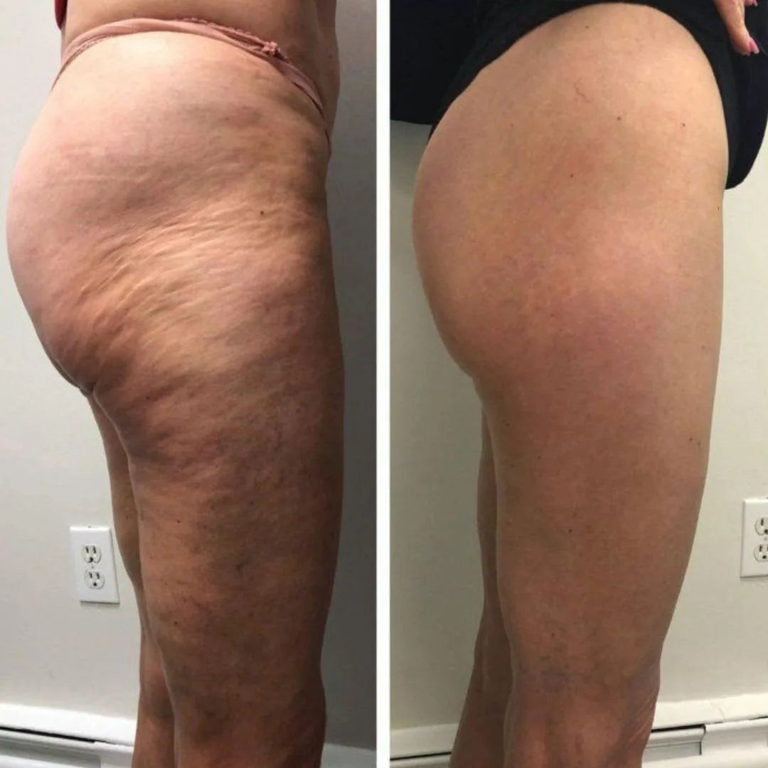 Before and after - tightened, smoother skin after 40