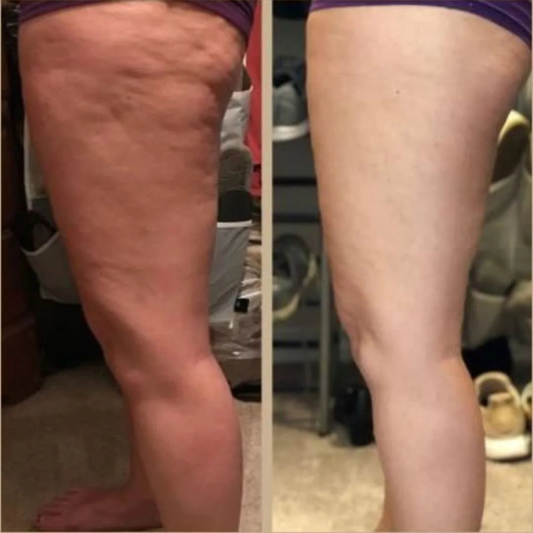Before and after - dimpling softened in 2 weeks