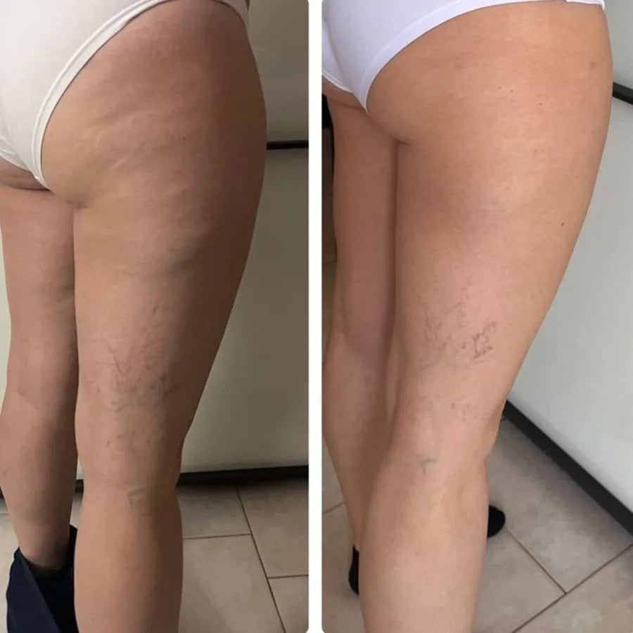 Before and after - firmer, lifted skin, dimpling fading