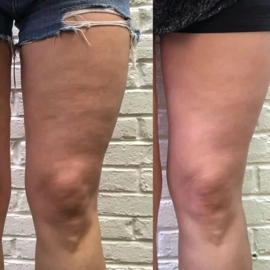 Before and after - firmer, lifted bottom after menopause