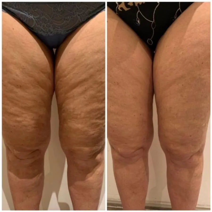 Before and after - real lift without surgery