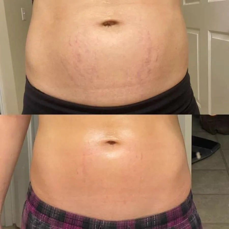Before and after grid - firmer, more lifted skin over 6 weeks